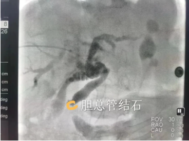 【钦中医技术】小针眼，大疗效——胆总管结石顺行球囊推石术（PTPBD）