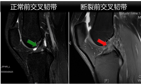 【钦中医技术】镜下重塑新“膝”望——关节镜下膝关节前交叉韧带重建术