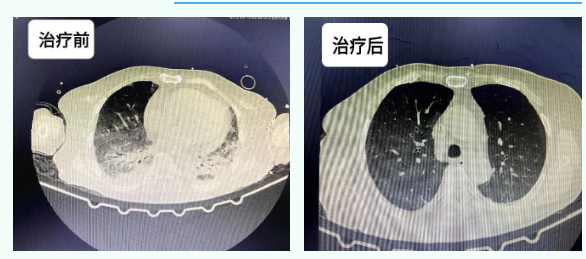 【钦中医技术】中西医结合挽救重症肺炎患者生命