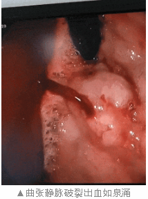 消化道出血中心显神通，快速止血救危在旦夕患者