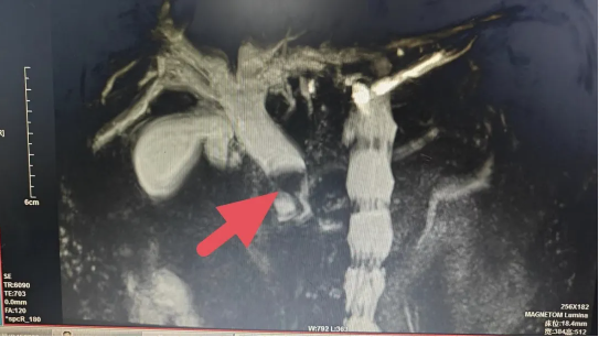 【中西医并重】胆胰结石困扰不再，ERCP技术显神威！