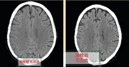 【钦中医技术】突发脑卒中刻不容缓，静脉溶栓挽回生命