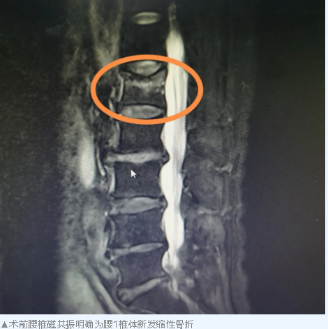 【中西医并重】经皮椎体成形术：让陈爷爷重拾挺起腰杆的自信