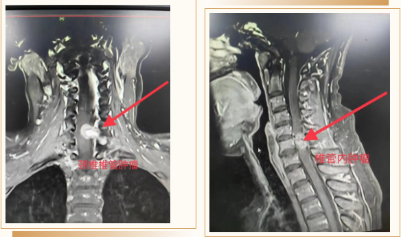 【骨科技术】截瘫女士重获新生：骨科专家精准切除椎管内肿瘤显神技