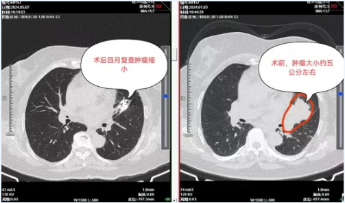 【中西医并重】碘125粒子植入术：点亮生命之光，中央型肺癌的温柔斗士